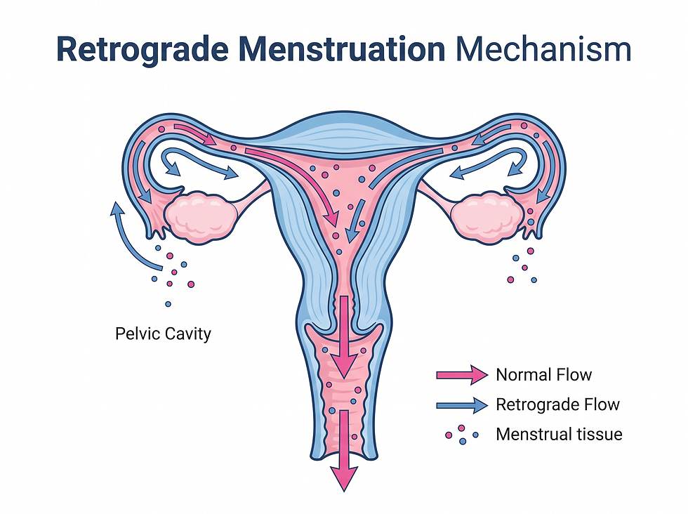 Diagram of the uterus, fallopian tubes, and ovaries showing normal menstrual flow out through the cervix and retrograde flow of menstrual tissue backward into the pelvic cavity.