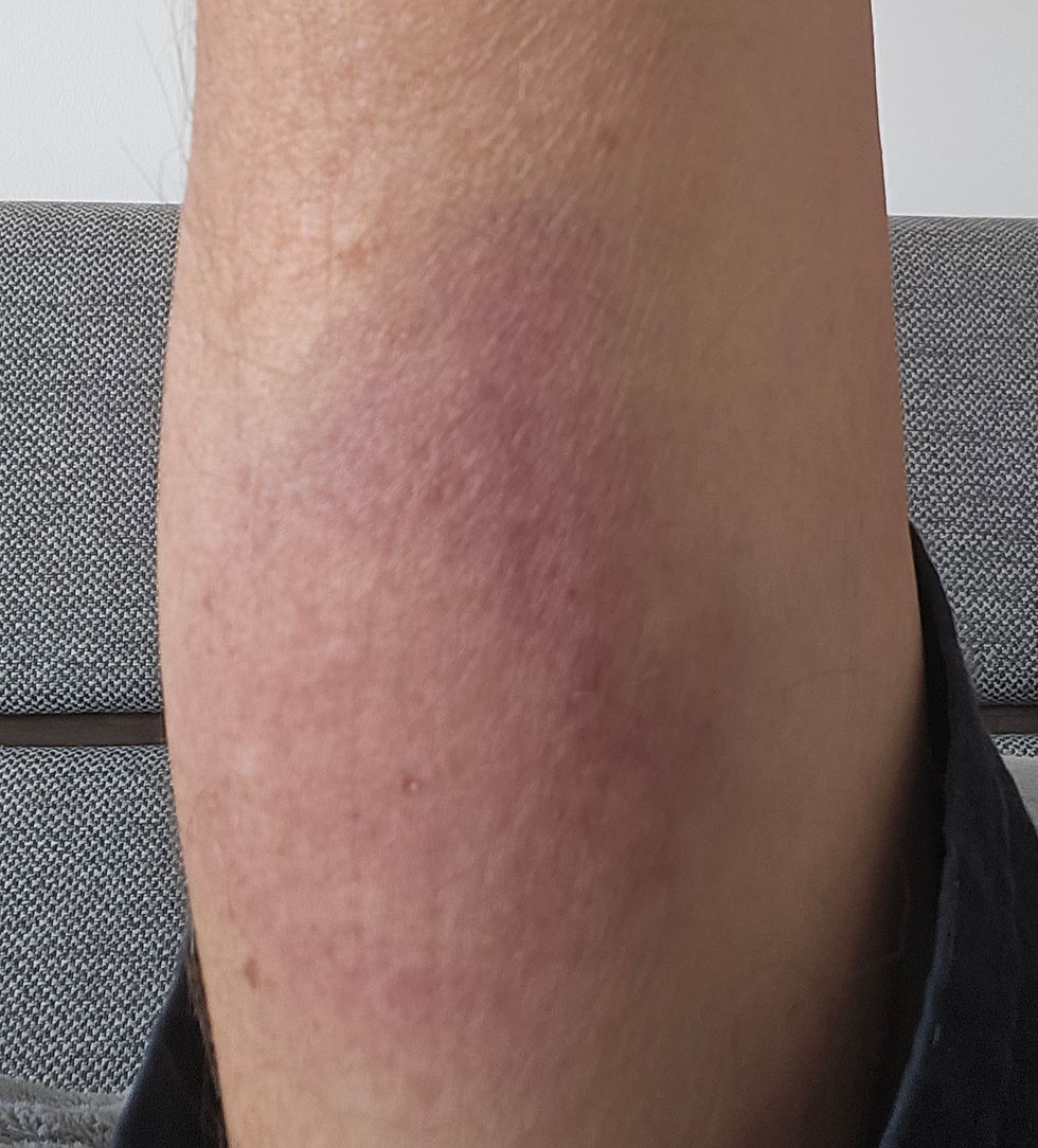 Bruise about the size of an orange!