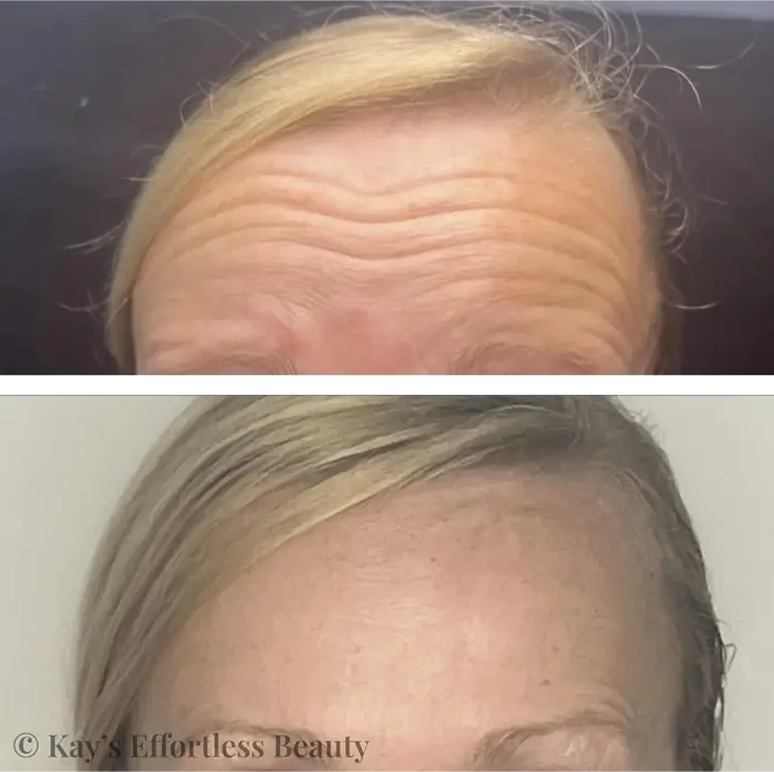 Before and after Botox treatment