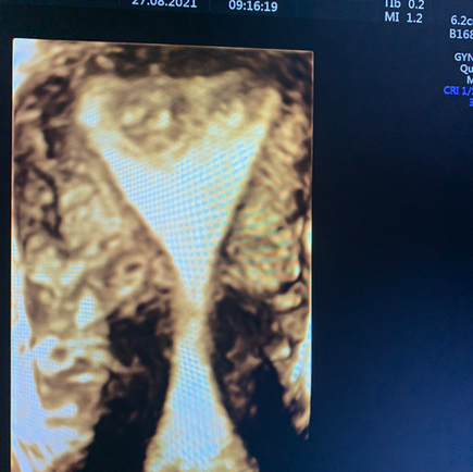 Ecografia ginecologica 3D: studio di fibromi e di malformazioni uterine