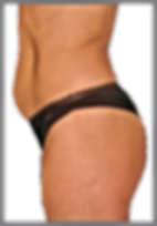Cryoslim Criolipolisis Cryolipolisys