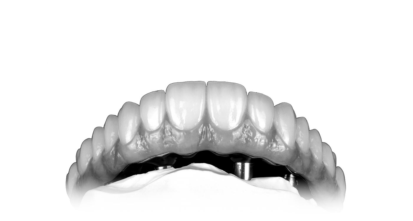 Full arch rehabilitations