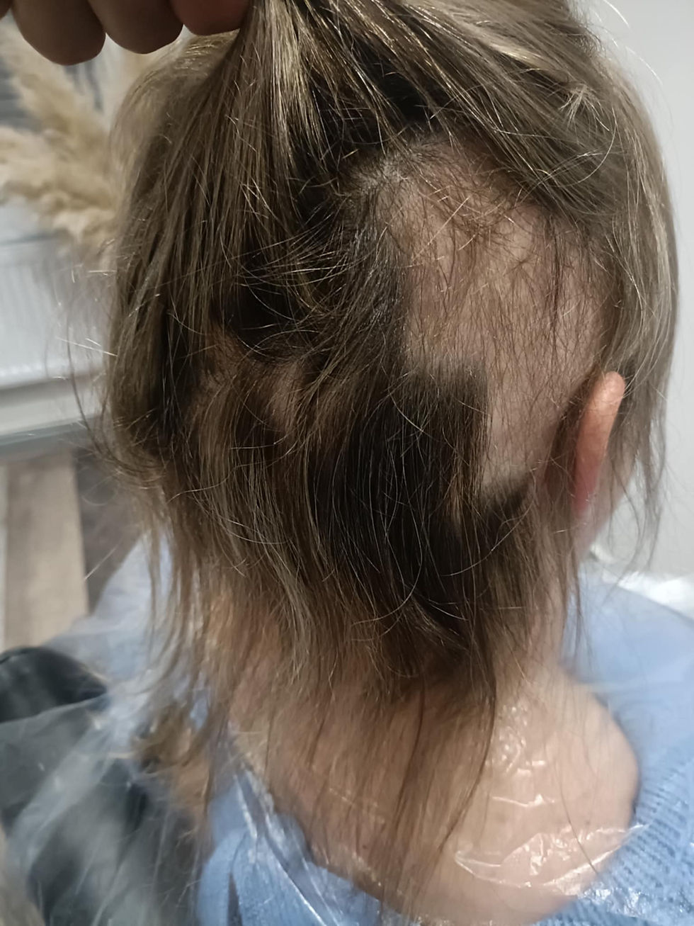 Thumbnail: PRP Hair restoration