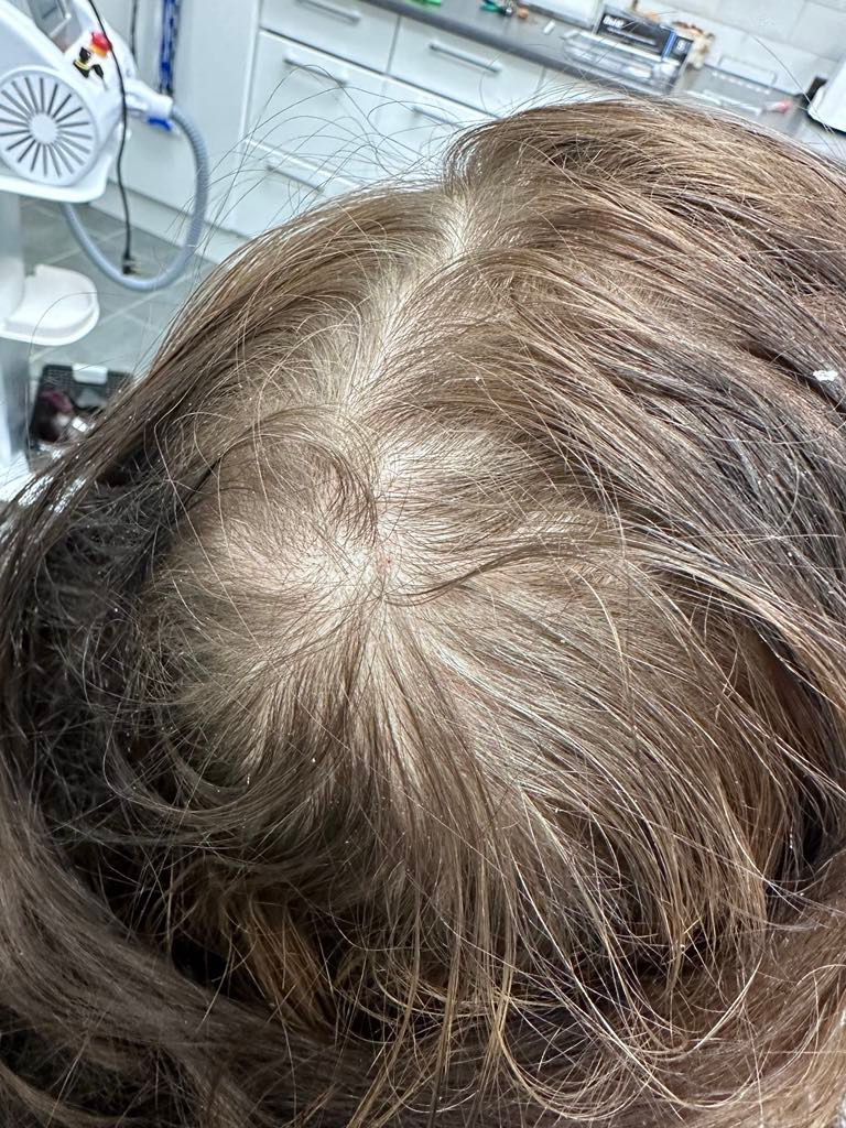 Thumbnail: PRP Hair restoration