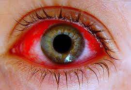 Enfermedades Oculares