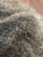 Seborrheic Dermatitis