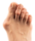 Bunions