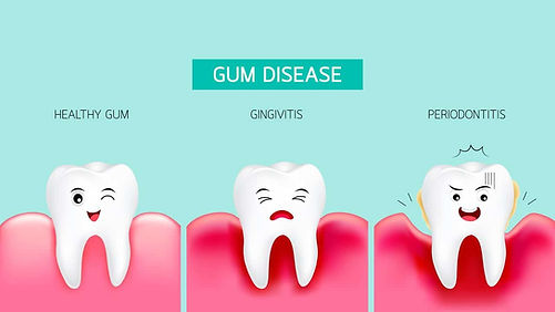 gum-disease-graphic-min.jpg