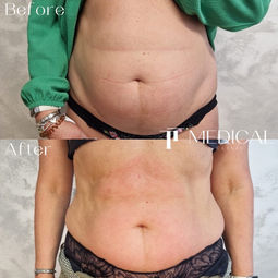 A before and after of a woman's abdomen following body sculpting treatment at TT Medical Clinic. Cavitation, fat melting, Radiofrequency