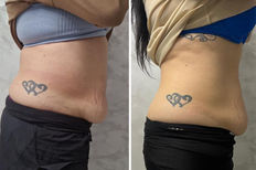 A before and after of a woman's abdomen following body sculpting treatment at TT Medical Clinic. Cavitation, fat melting, Radiofrequency