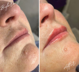A before and after image of of a woman's lips having had lip filler at TT Medical Clinic