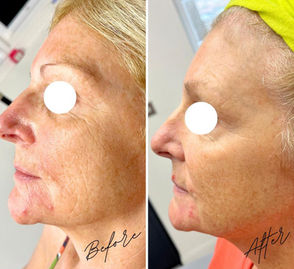 A before and after of a woman who has undergone Radiofrequency microneedling treatment at TT Medical Clinic