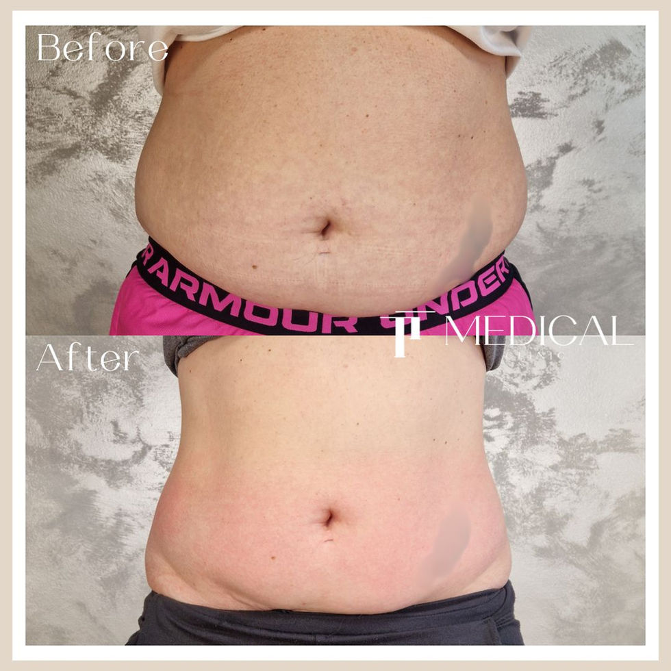 Before and after 3d aesthetics TT Medical Clinic body sculpting