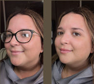 A before and after image of of a woman's lips having had lip filler at TT Medical Clinic
