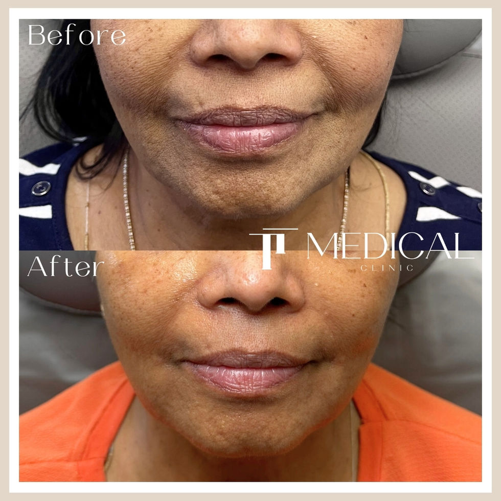 TT Medical Clinic Maesteg Before and After images of nasolabial and marionette dermal filler