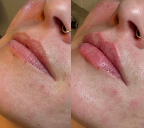 A before and after image of of a woman's lips having had lip filler at TT Medical Clinic