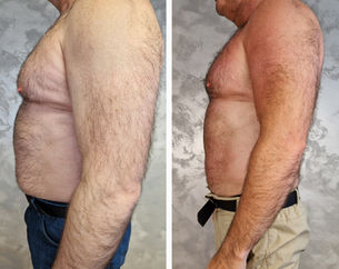 A before and after of a man's abdomen following body sculpting treatment at TT Medical Clinic. Cavitation, fat melting, Radiofrequency