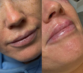 A before and after image of of a woman's lips having had lip filler at TT Medical Clinic
