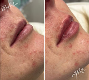 A before and after image of of a woman's lips having had lip filler at TT Medical Clinic