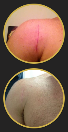 Before and after pic of client demonstrating significant healing of a surgery site resulting in a barely noticeable scar.