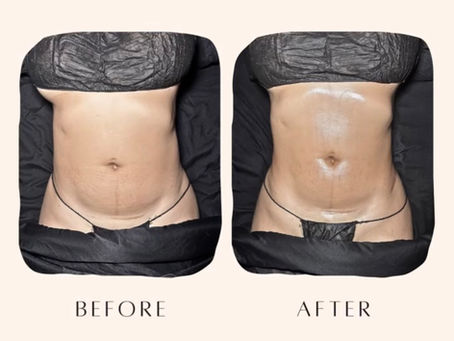 before and after results for stomach sculpting