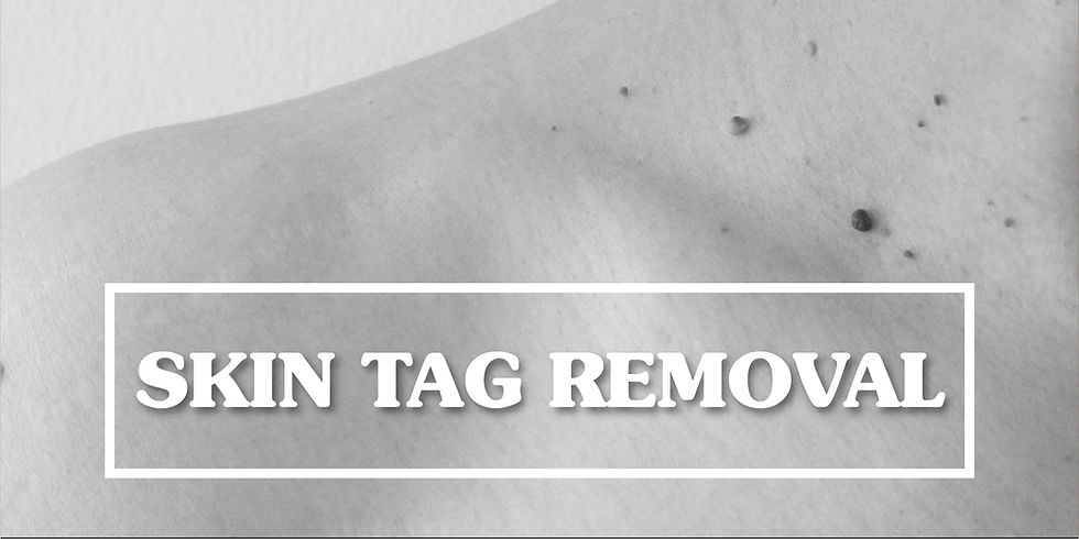 Skin Tag Removal