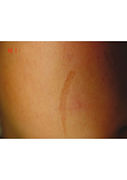 Vascular Pigmentation-Before-scar-on-cheek