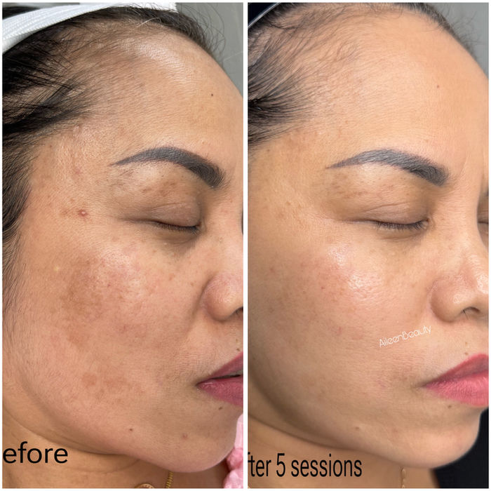 Before and after photos of a woman's face showing skin improvement after 5 sessions, text: 'before', 'after 5 sessions', 'Aileen's Beauty'