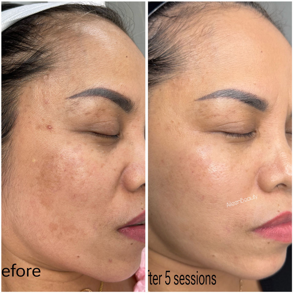Before and after photos of a woman's face showing skin improvement after 5 sessions, text: 'before', 'after 5 sessions', 'Aileen's Beauty'