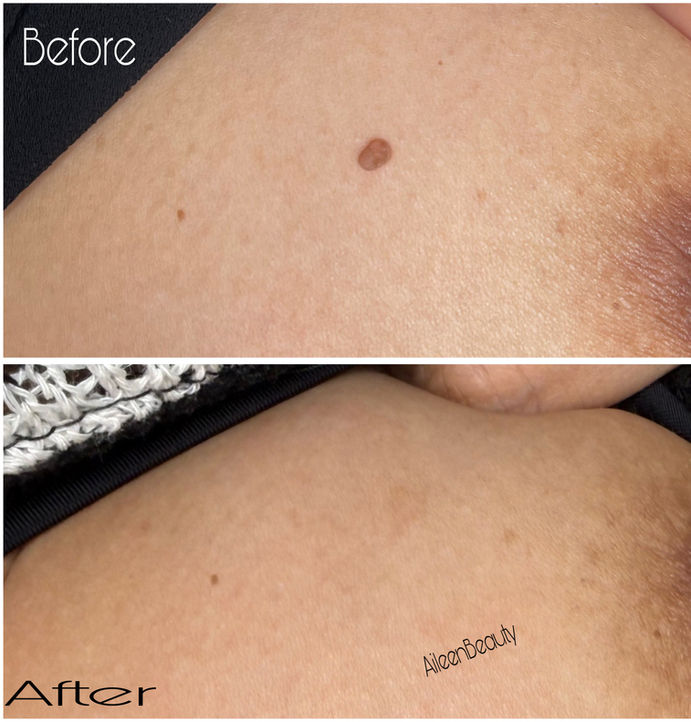 Before and after photos showing skin discoloration treatment results, labeled 'Before' and 'After', AileenBeauty