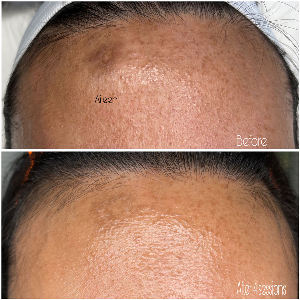 Aileen's forehead before and after 4 sessions of treatment for hyperpigmentation