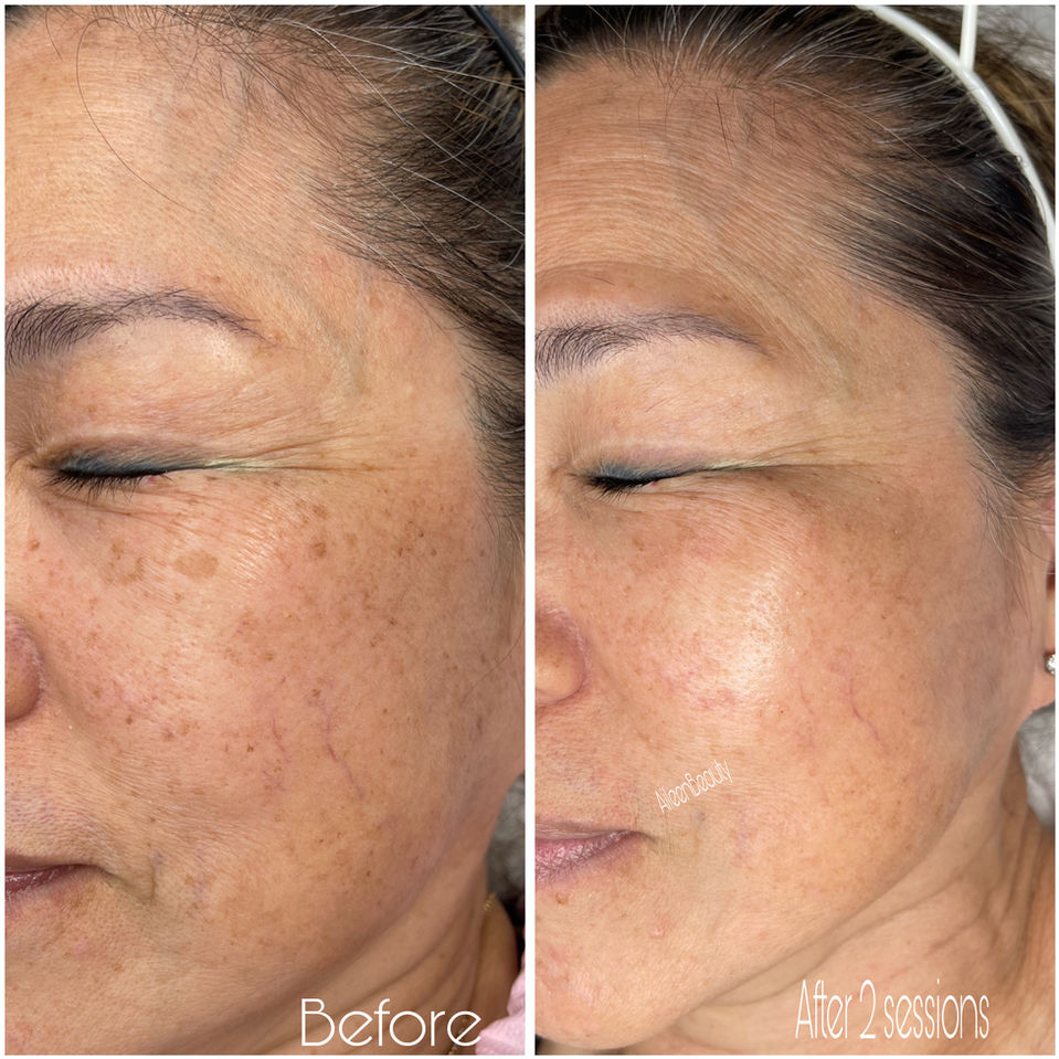 Before and after photos showing skin improvement after two sessions