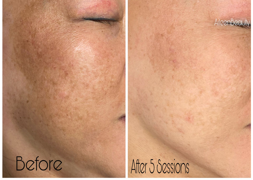 Before and after 5 sessions, showing skin improvement with reduced hyperpigmentation, Aileen Beauty