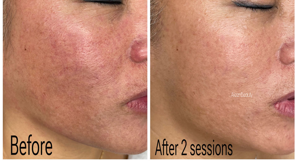 Before and after skin treatment results, showing improvement after two sessions, Aileen's Beauty