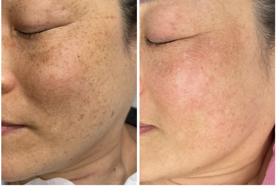 Before and after skin treatment showing reduction in hyperpigmentation