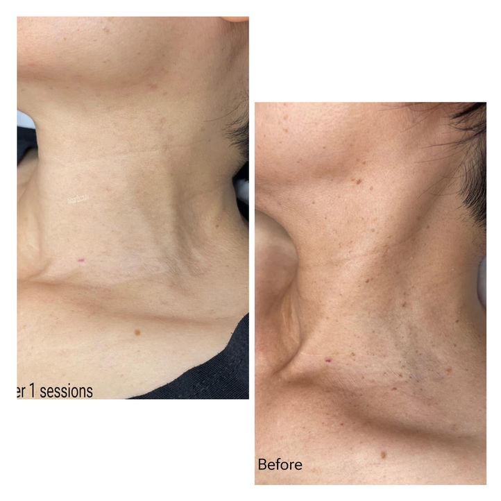Neck before and after 1 session of Wrinkle Treatment, showing smoother skin.