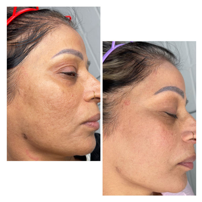 Before and after photos of a woman's face showing skin improvement with Aileen's Beauty