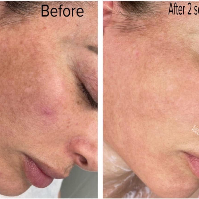 Before and after photos showing skin improvement after 2 sessions