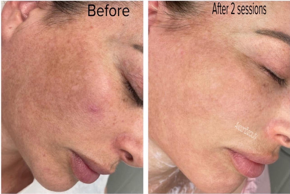 Before and after photos showing skin improvement after 2 sessions