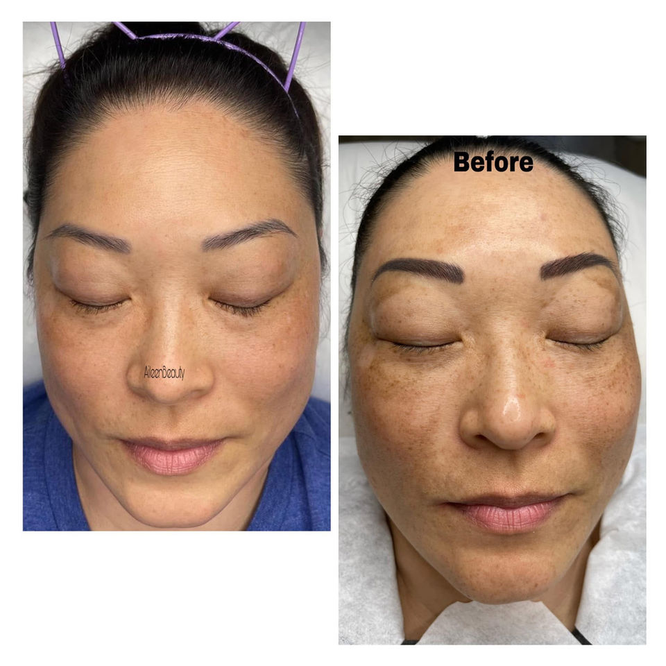 Woman's face before and after treatment, showing improvement in skin tone and clarity, Before