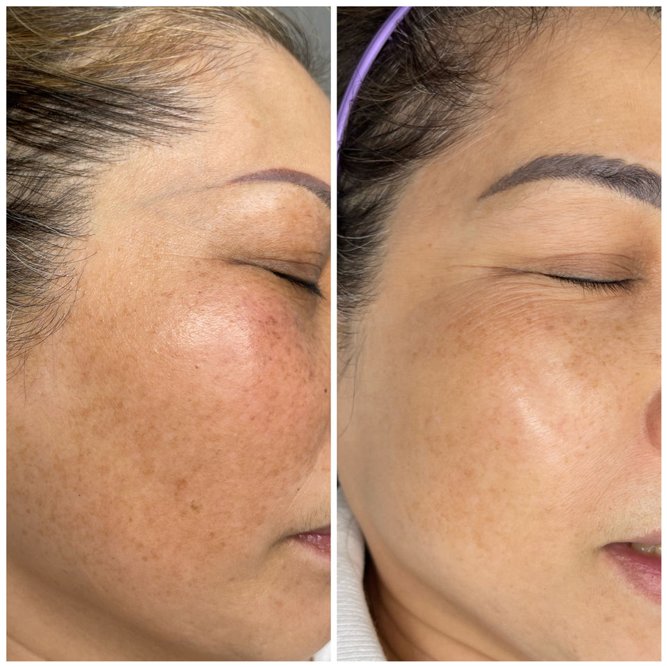 Before and after photos showing skin improvement