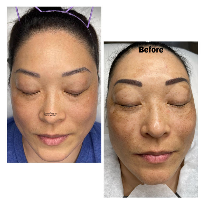 Before and after photos of a woman's face showing skin tone improvement, Before text is visible.