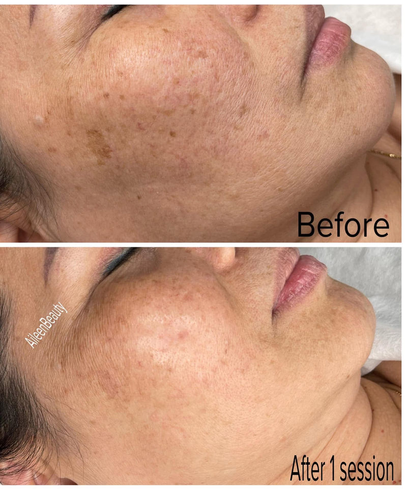 Before and after photos of a woman's face showing skin improvement after one treatment session at Aileen Beauty