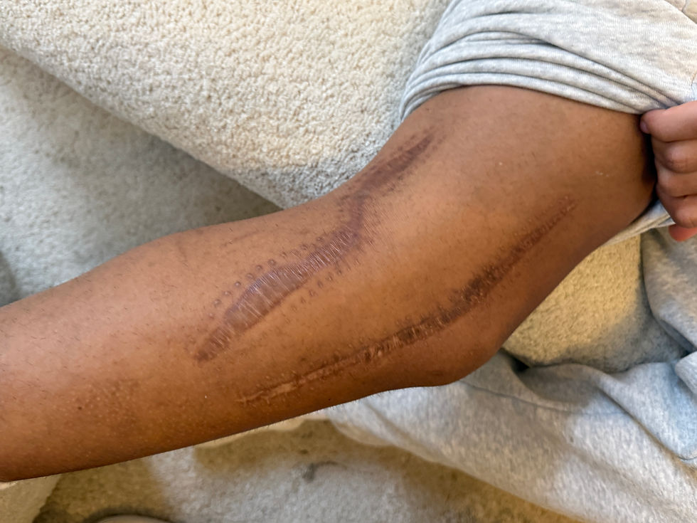 ALVORLIG: Jacob har ett arr for en operasjon i Oslo og ett for en operasjon i Danmark. Foto: NISO/Baardsen Sport