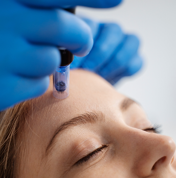 microneedling at juvon skincare and wellness
