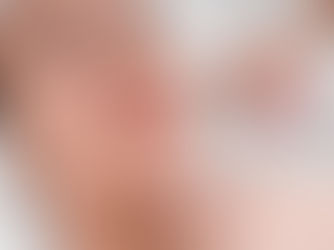 Preenchimento com Ácido Hialurônico: Transforme Sua Pele com Resultados Naturais