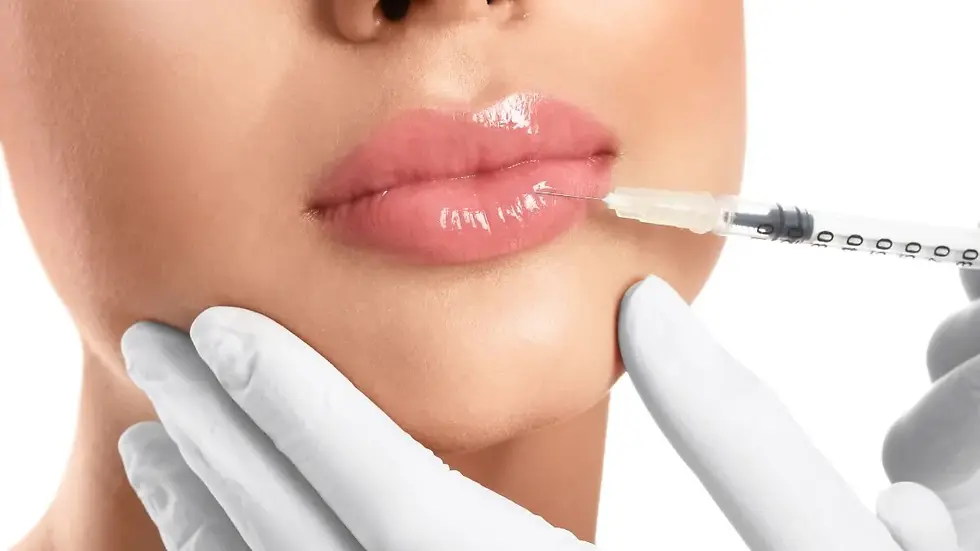 Aplicação de preenchimento labial com seringa em lábios femininos, realizada por profissional com luvas.
