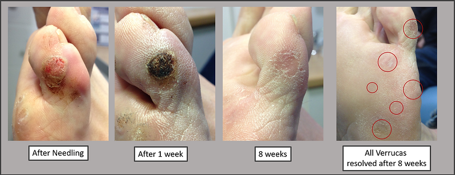 Verruca Needling Process and Results 