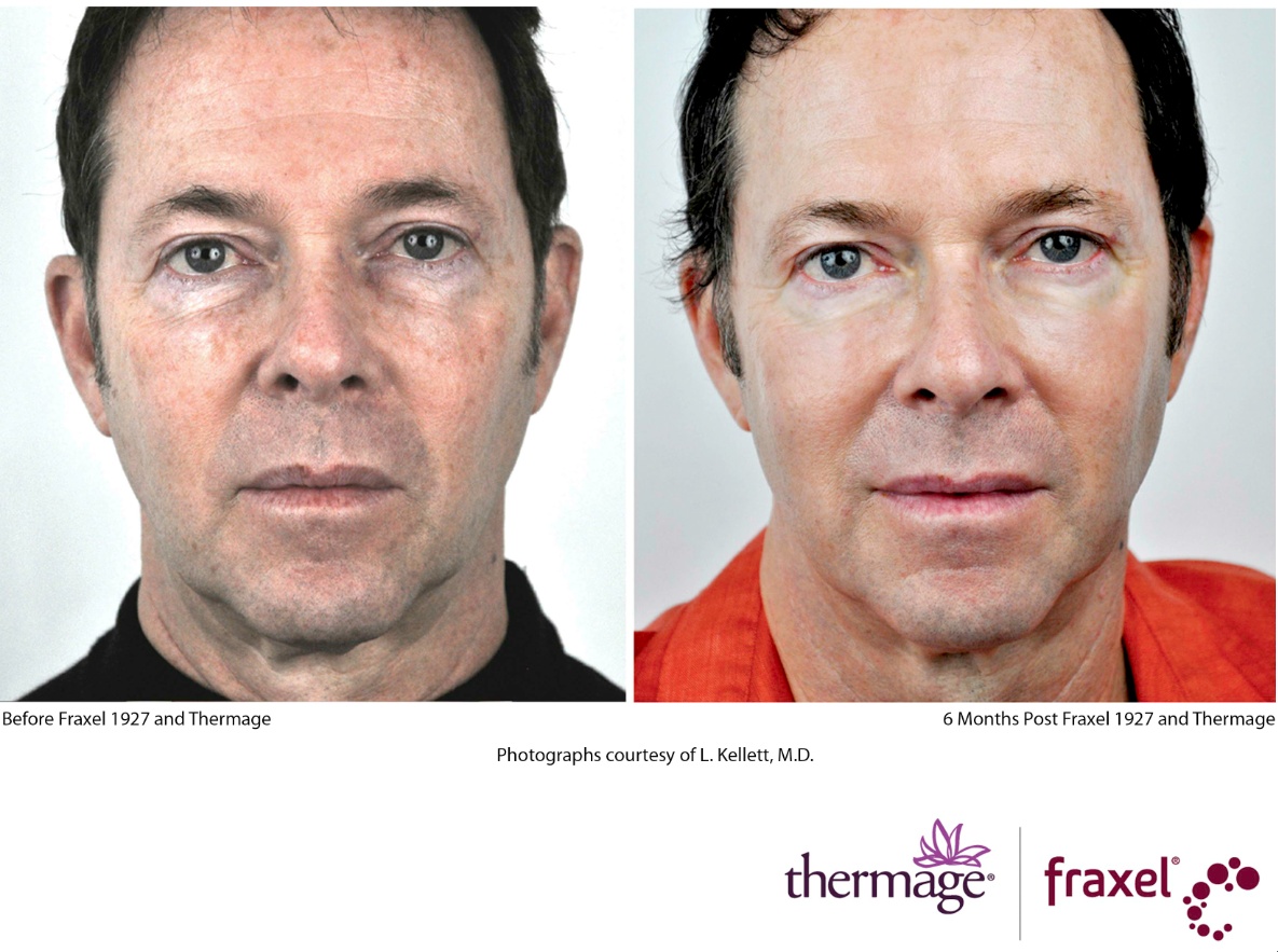 thermage fraxel men.png