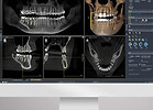 Cone Beam 3D pour la planification implantaire